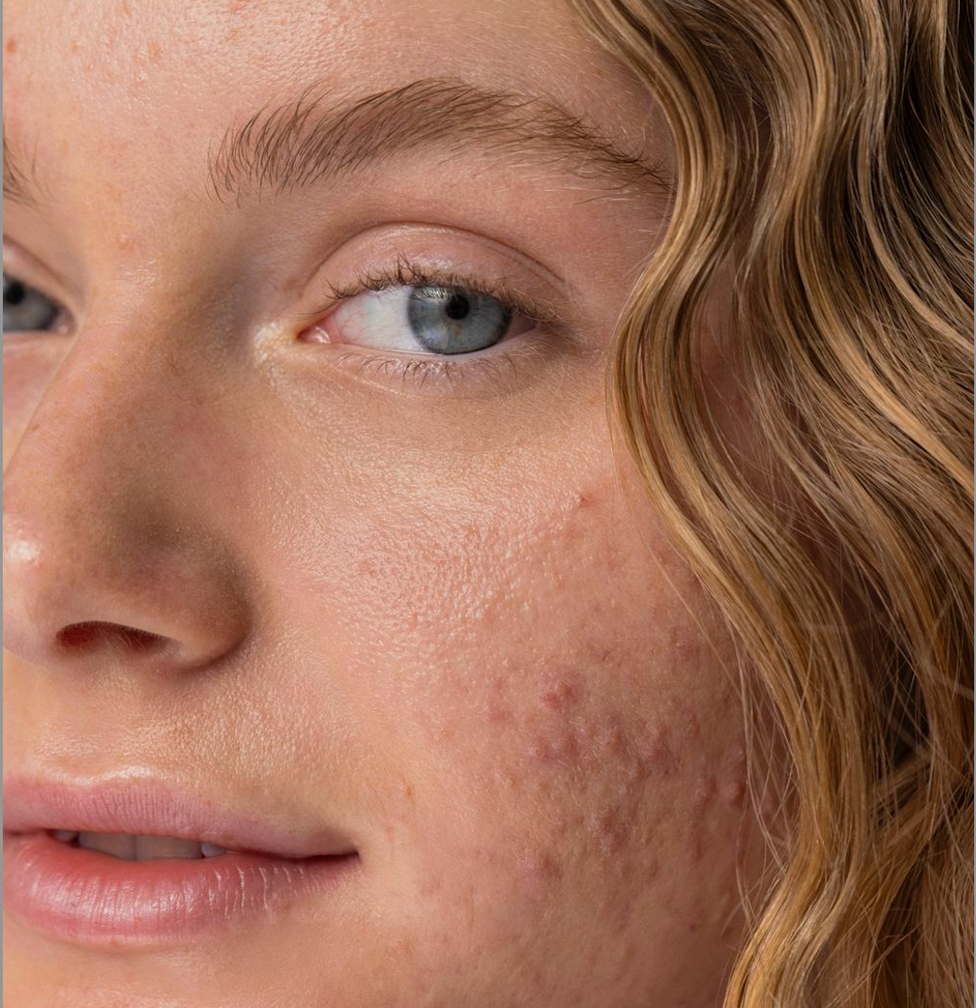 LED Terapia vs. Akné: všetky výhody a ako funguje